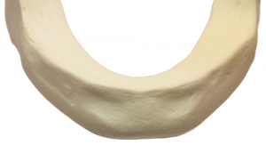 Whats In a Bone Graft