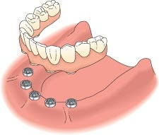 图显示了下颌种植体支撑的牙桥