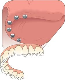 图显示了一个固定的上颌种植体支撑的牙桥
