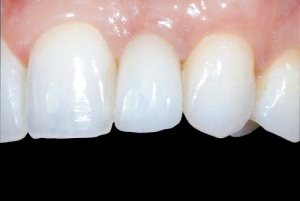 Single tooth replaced with a dental implant