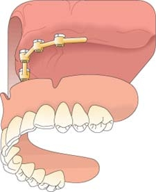 图显示了一个可拆卸的上颌支撑覆盖义齿
