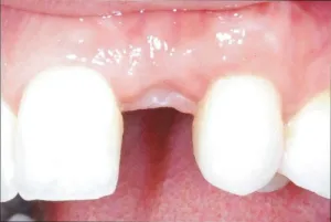 Отсутствие одного зуба перед заменой на дентальный имплант.